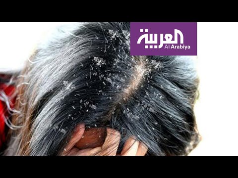 الحل النهائي للتخلص من قشرة الرأس من دون معاناة