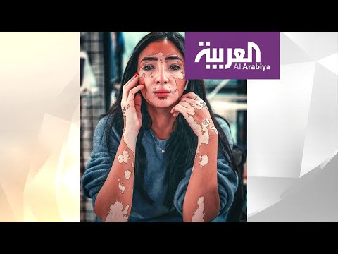 مدونة مصرية حولت إصابتها بالبهاق إلى نجاح